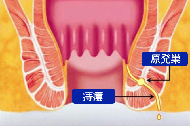 肛門周囲膿瘍からろう管が形成された状態